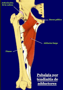 Pubalgia aguda